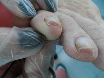 Нанесите каплю лимонного сока и немного меда прямо на палец