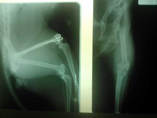 Остеосинтез бедренной кости