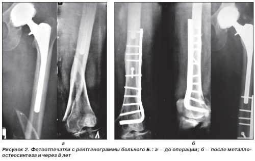Повреждения бедра обычно свойственно пожилым людям