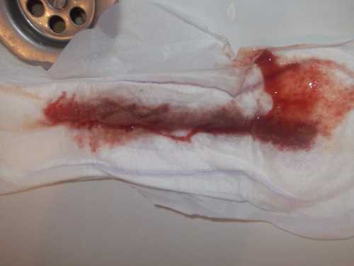 Выделения при беременности