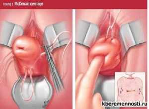 Отек промежности во время родов если родовая деятельность протекает вяло или схватки слишком затянулись во времени, может отекать промежность, что приводит к разрывам