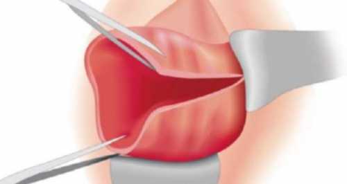 Преждевременные потуги нередко являются причиной разрывов в родах наступает момент, который необходимо передышать, не допуская натуживания