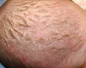 У грудных детей появление корочек явление очень распространенное