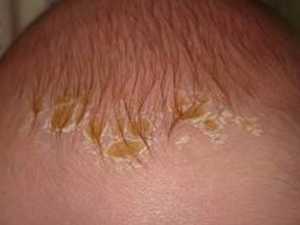 Корочки на голове у грудничка