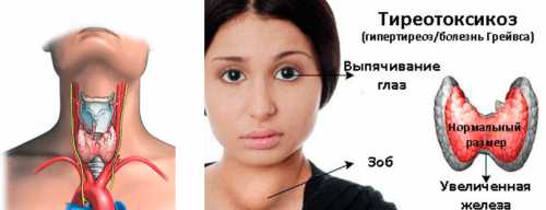 Гипертиреоз у женщин