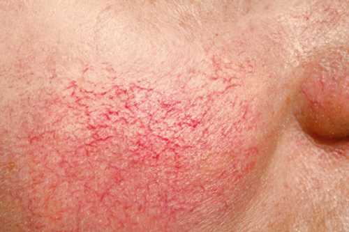 Не менее результативно лечение сосудистых купероза в домашних условиях маслами