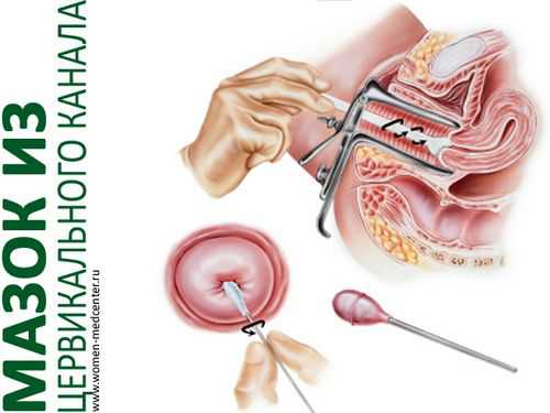 Лейкоциты в цервикальном канале