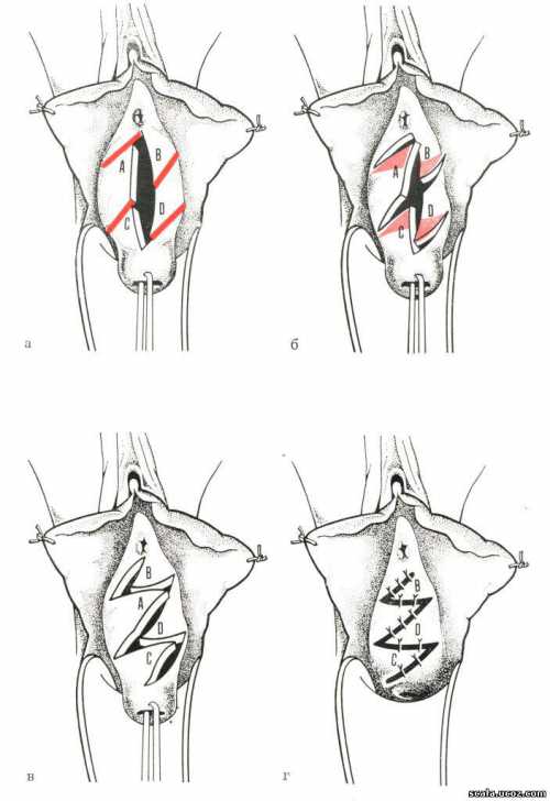 Метронидазол