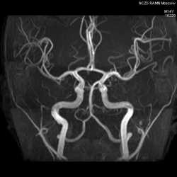 Контрастное вещество усиливает изображение капилляров и сосудов, сформированных в районе опухоли
