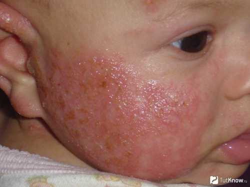 Вначале дают пюре из одного вида овощей, затем состав расширяют раз в дня