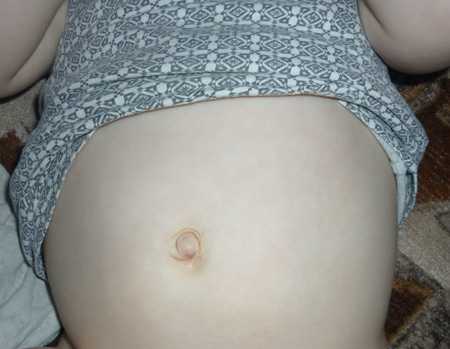 Приобретенные паховые грыжи у детей встречаются редко