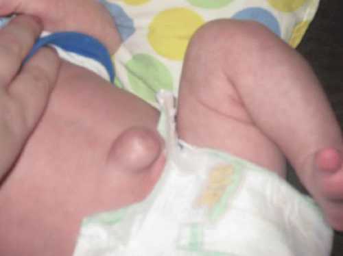 Они возникают вследствие патологии развития круглых связок матки