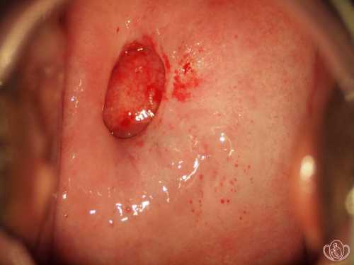 Большинство случаев заболевания выявляется либо при плановом медосмотре, либо при обращении пациентки к гинекологу по другому поводу