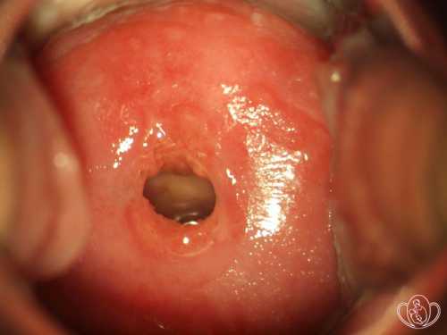 Цервицит шейки матки