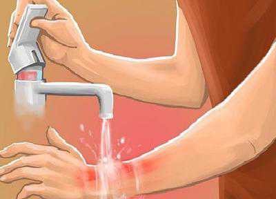 Спустя каждые полчаса надо менять бинтовую повязку. Кроме того можно пользоваться листом алоэ, предварительно разрезав его во продольной плоскости