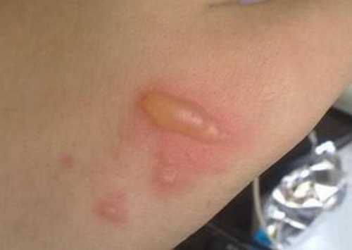 Лечение ожогов в домашних условиях