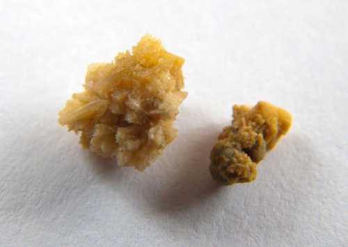 Конкременты в почках