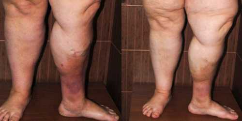 Если сильно промерзают ноги, скорее всего, это связано с нарушениями кровообращения или сбоями в функции нервной системы