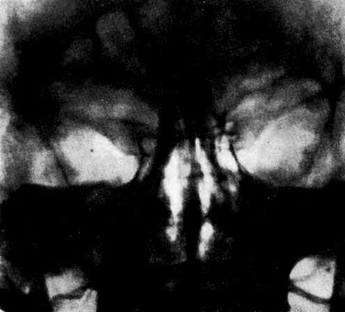 А лучшая защита оказывается в том, чтобы не дать вирусу возможности питаться гноем в нашем организме